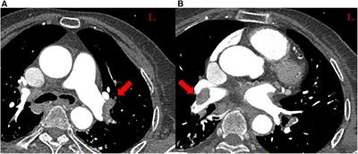 Case Report: Thrombus aspiration and in situ thrombolysis via a Guidezilla guide extension catheter in a patient with high-risk pulmonary embolism
